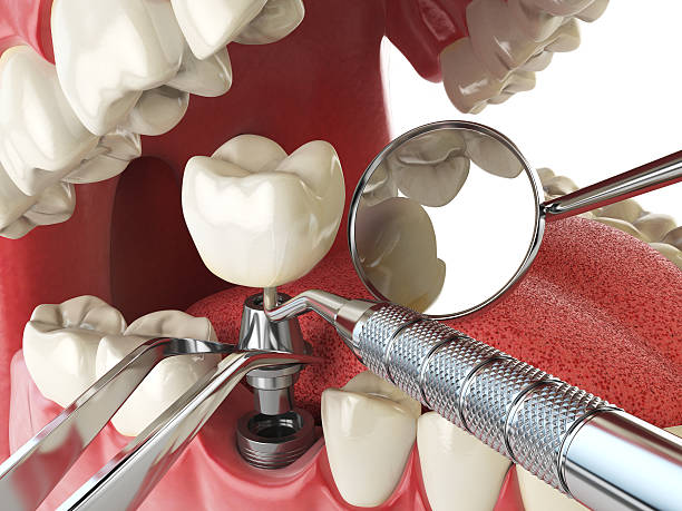 Best Emergency Dental Extractions in Brocton, NY